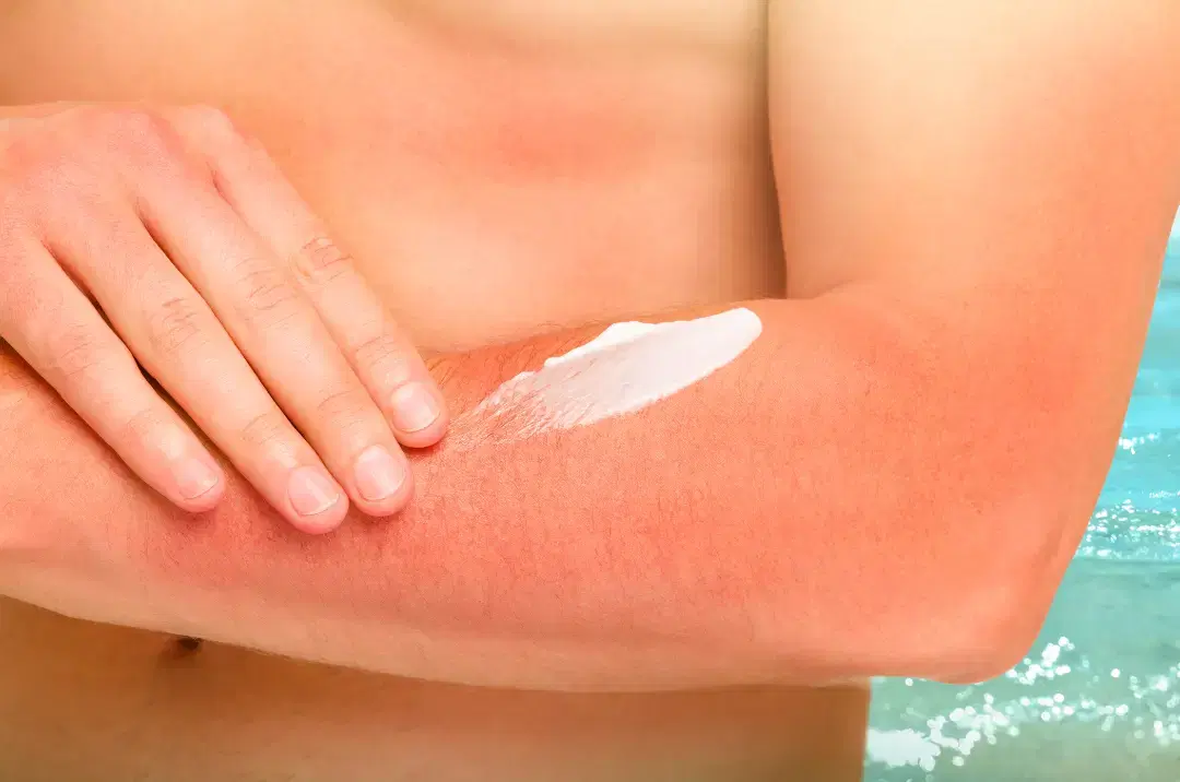 Aloe-based treatment for razor burn and post-depilatory cream aftercare