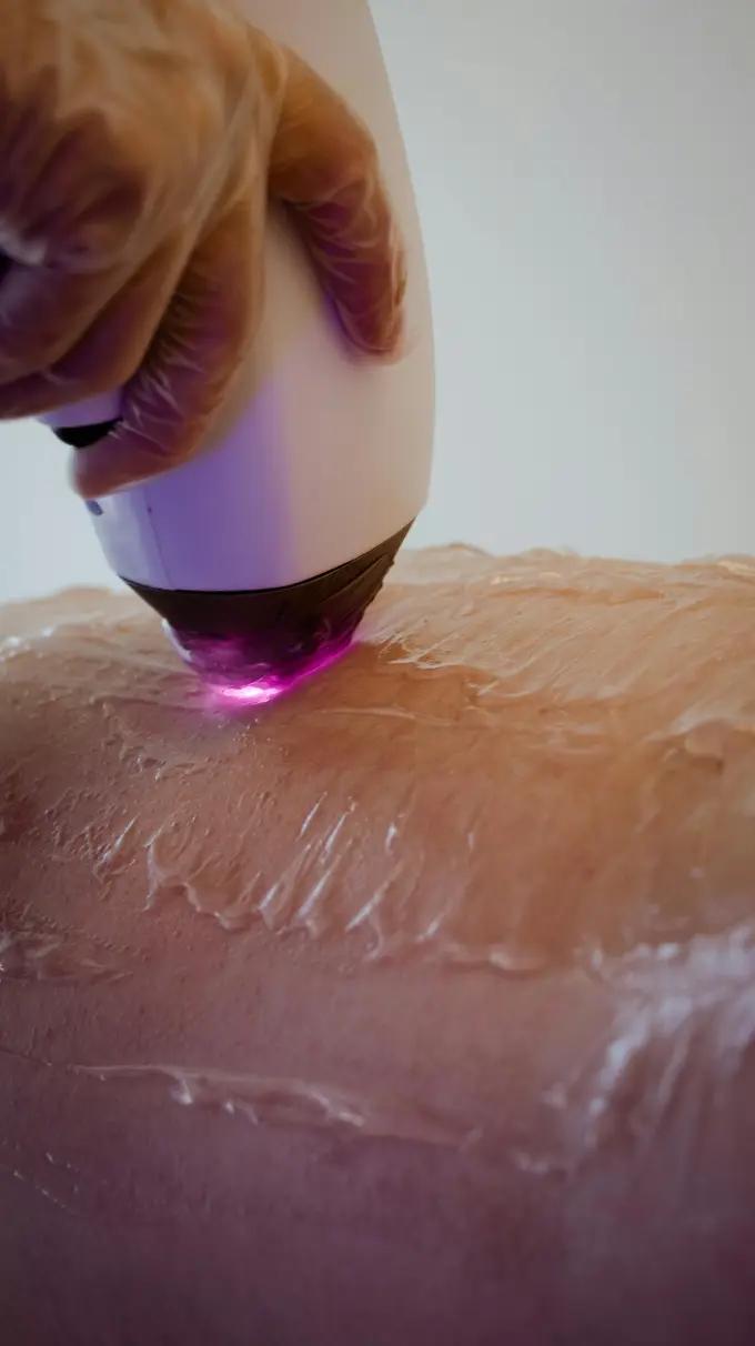 Close-up of an at-home IPL hair-removal device in use on the skin